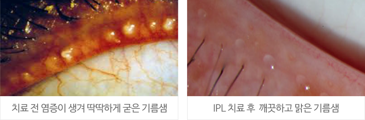 치료 전 염증이 생겨 딱딱하게 굳은 기름샘(좌) / IPL 치료 후 깨끗하고 맑은 기름샘(우)