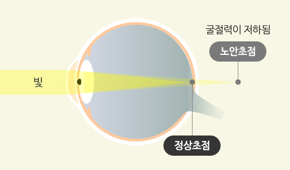 노안 안구 이미지