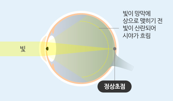 백내장 안구 이미지